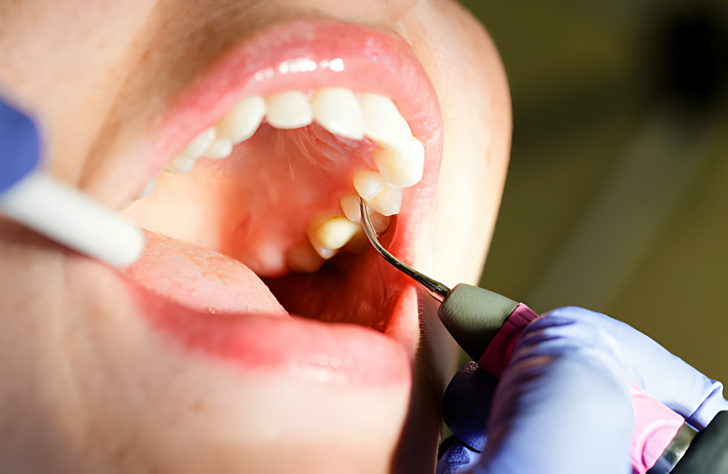 лечение периодонтита зуба