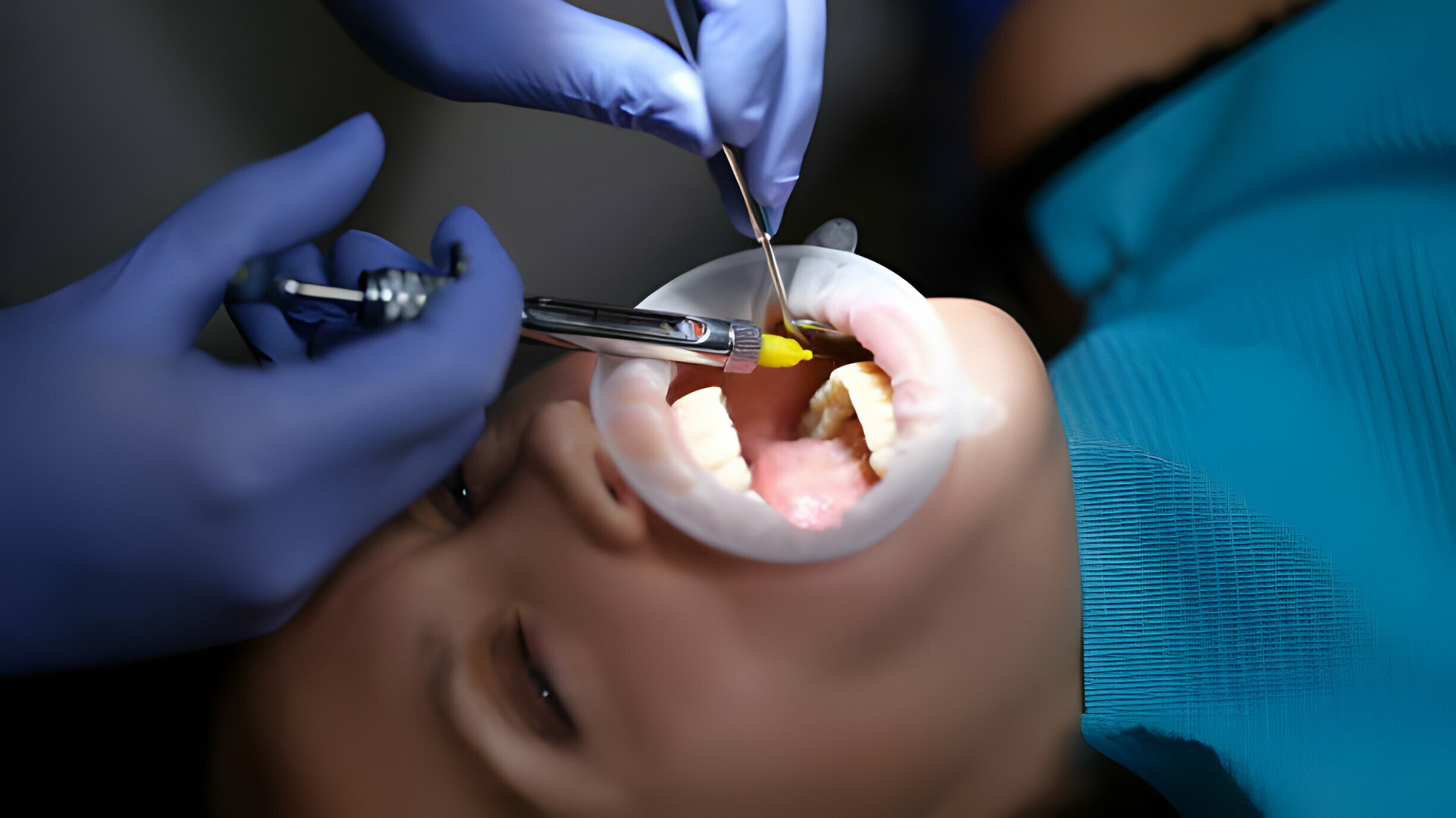 лоскутное лечение зуба