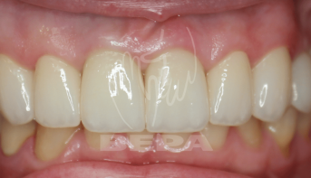 протезирование зубов циркониевыми коронками